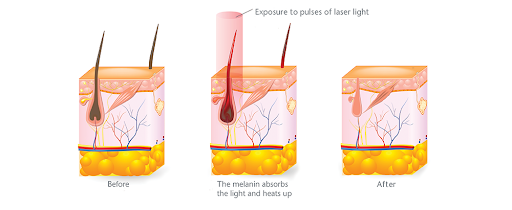 Triple Wave Diode Laser Hair Removal xstore medical